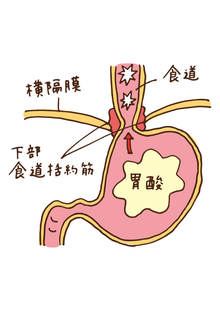 逆流性食道炎イメージ