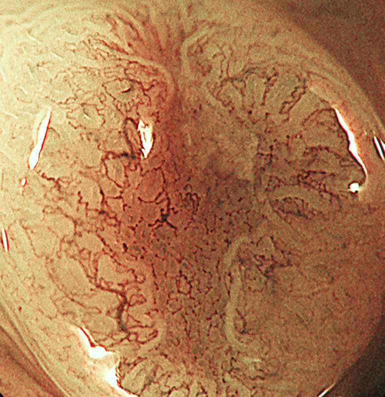 3mmの陥凹型（へこんだ）大腸腫瘍